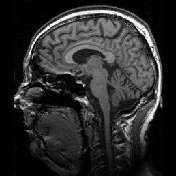 Mri Brain Sagittal